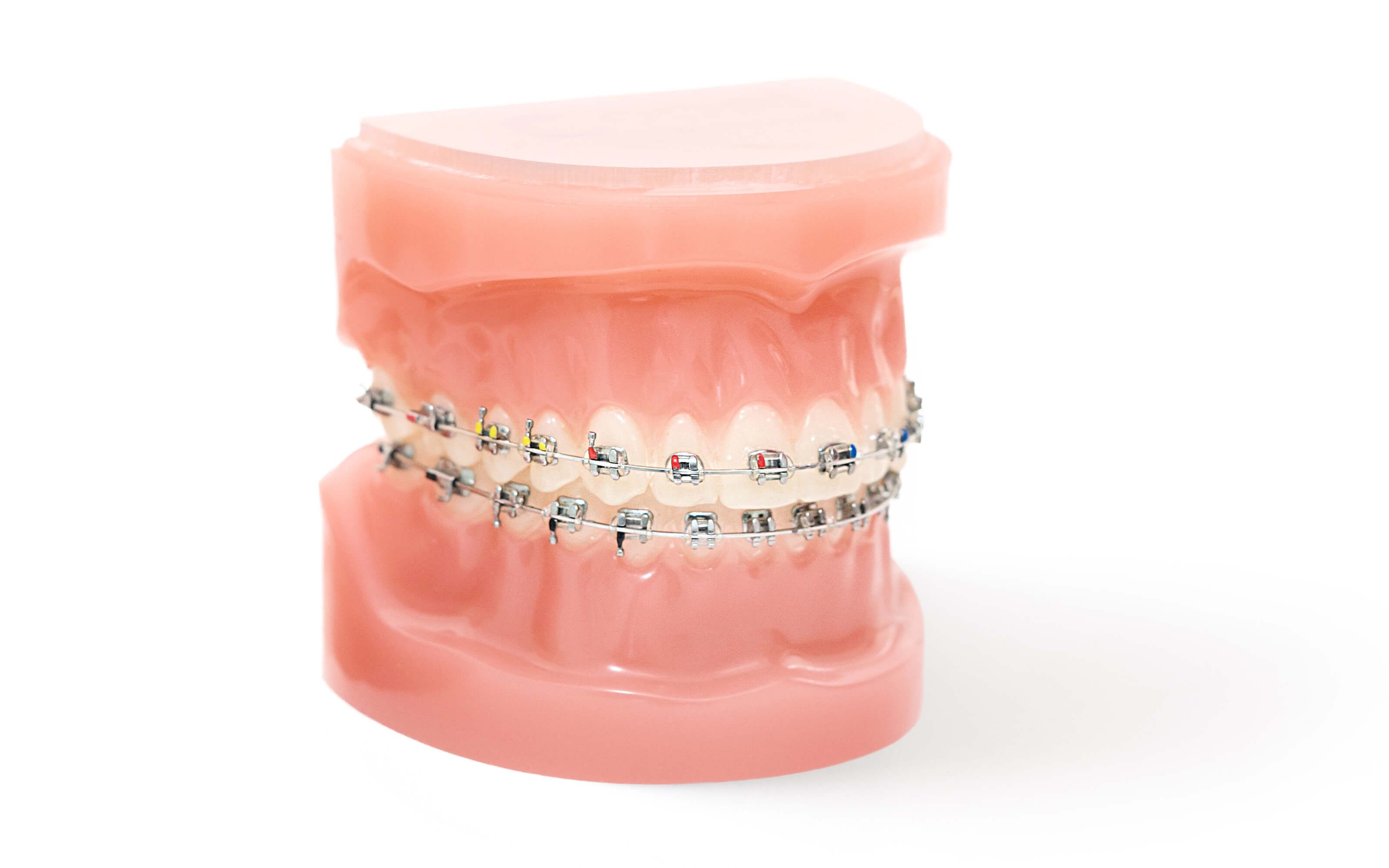 Beim Kieferorthopäden dient die Multiband- oder Multibracket-Technik bei der Teile der Behandlungsapparatur fest mit den Zähnen verbunden werden